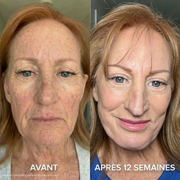 Avant / après 12 semaines — résultats individuels, non garantis